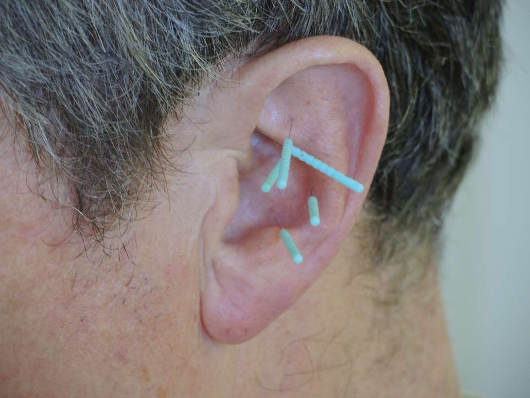 Akupunktur am Ohr mit je 5 Nadeln pro Ohr